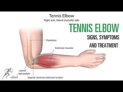 Tennis elbow: Signs and symptoms and treatment of the common elbow injury
